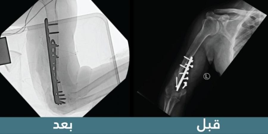 "سعود الطبية" تنهي معاناة استمرت 19 عامًا لمريض فقد حركة الكوع - ستاد العرب