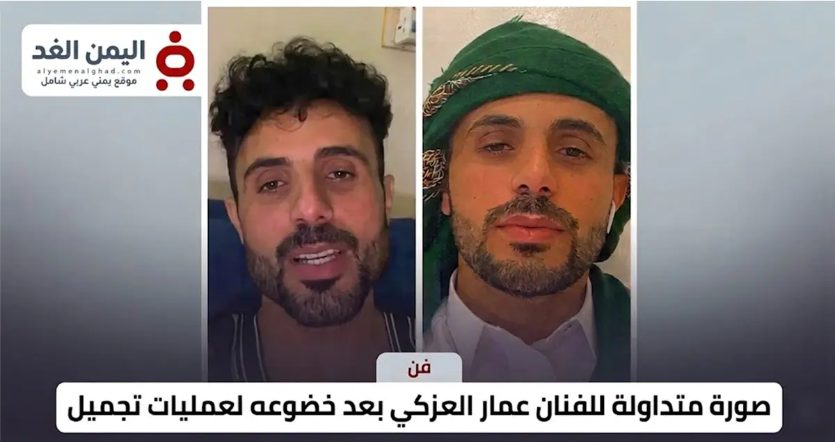 صدمة وتفاعل واسع.. ملامح جديدة للفنان عمار العزكي بعد خضوعه لعملية تجميل (صورة)